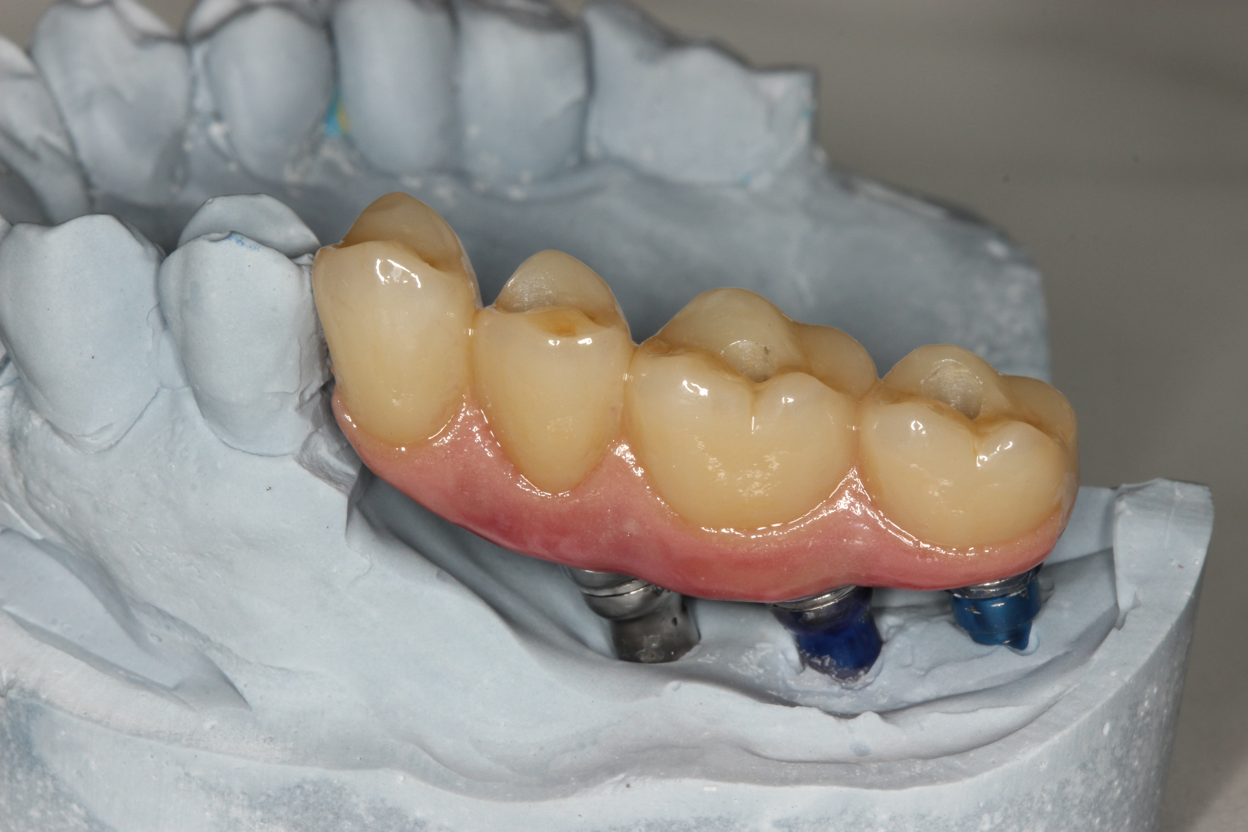 Циркониевая коронка на имплант