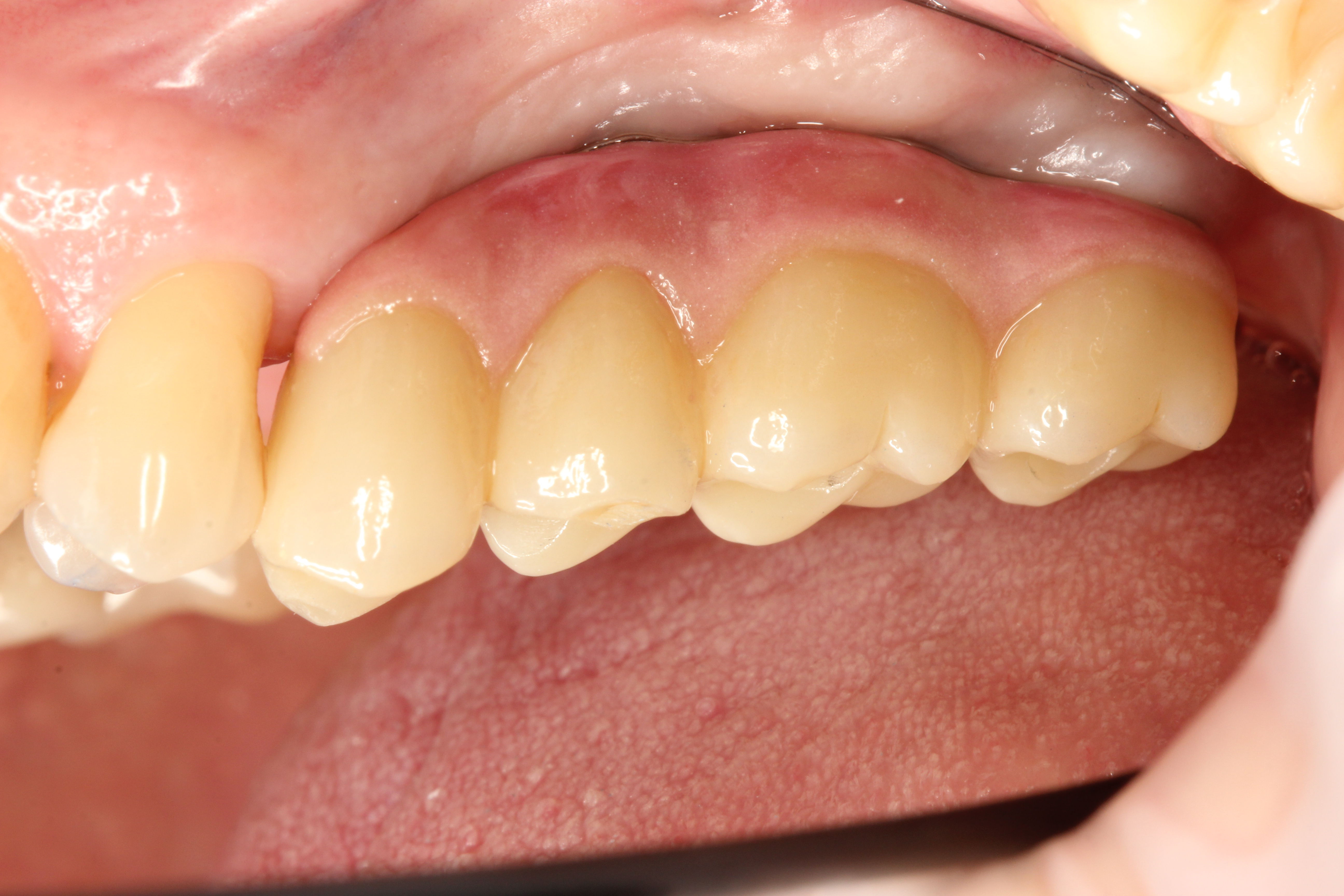 Коронка на свой зуб