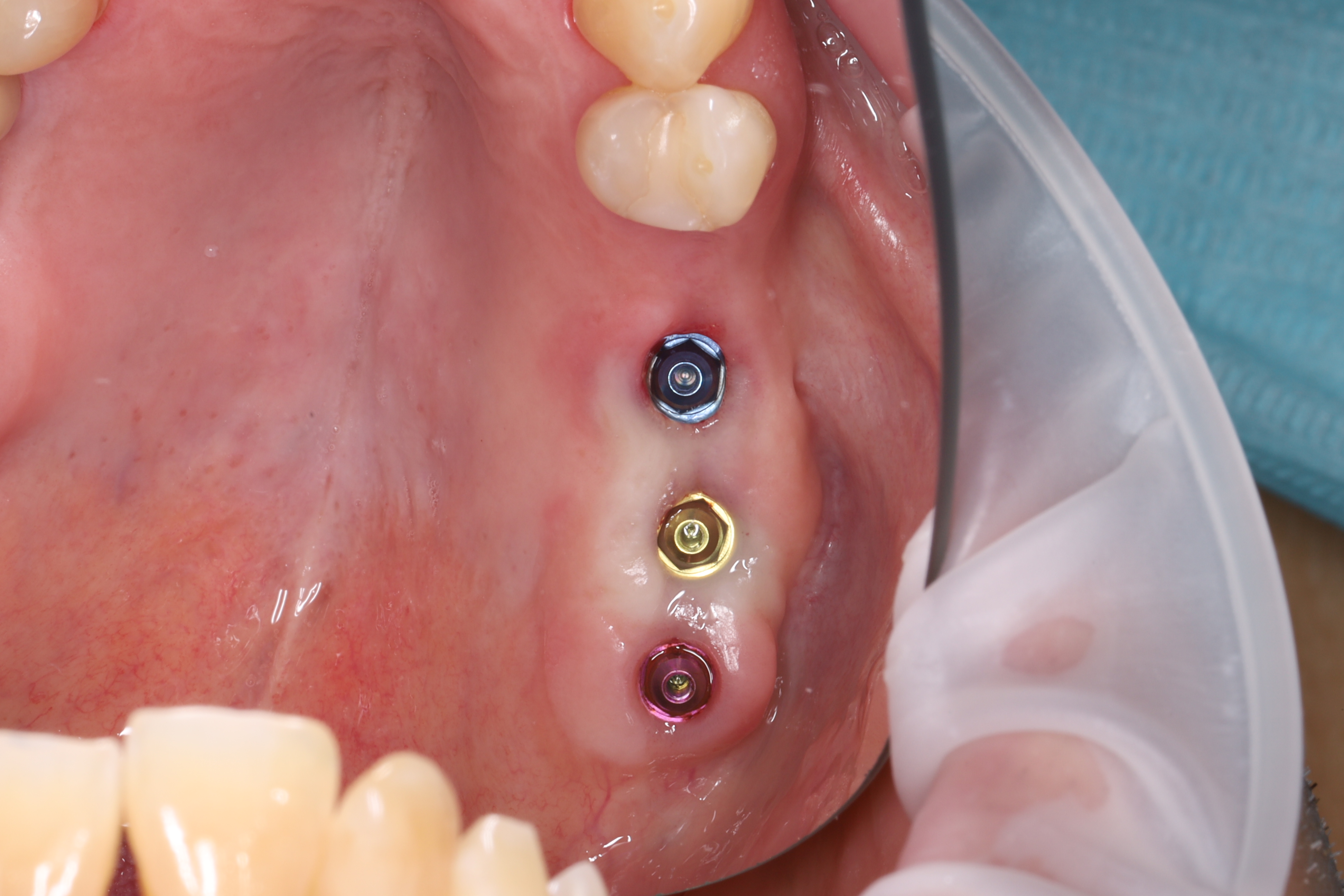 Слепок и изготовление